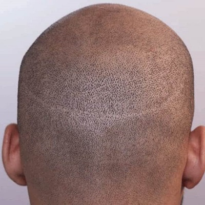 زراعة الشعر الشريطي في دبي وأبو ظبي عيادة التجميل في دبي