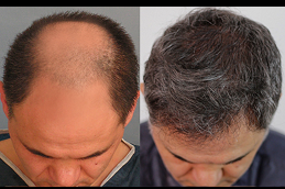 أفضل تكلفة لزراعة الشعر في دبي