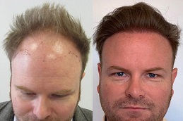 أفضل تكلفة لعيادة زراعة الشعر في دبي وأبو ظبي