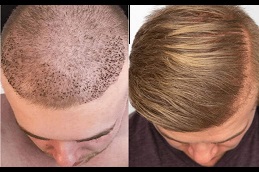 أفضل تكلفة لعيادة زراعة الشعر في دبي