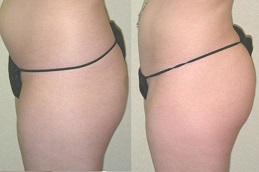 أفضل خدمة حقن للدهون في دبي