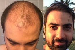 أفضل زراعة شعر DHI في دبي