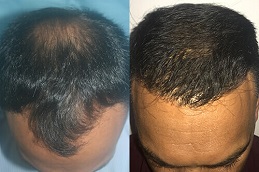 أفضل زراعة شعر في دبي