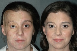 أفضل علاج للحروق في دبي