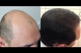 أفضل عيادة DHI لزراعة الشعر المباشر في دبي وأبو ظبي