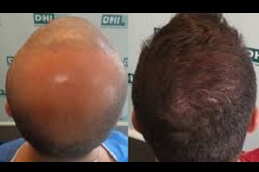 أفضل عيادة DHI لزراعة الشعر في دبي