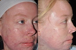 أفضل عيادة ترميم الحروق في دبي وأبو ظبي