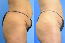 أفضل عيادة حقن الدهون في دبي