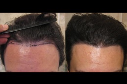 أفضل عيادة زراعة الشعر في دبي وأبو ظبي