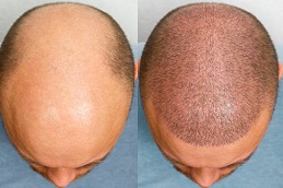 أفضل عيادة لزراعة الشعر في دبي