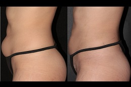 أفضل عيادة نقل الدهون في دبي وأبو ظبي