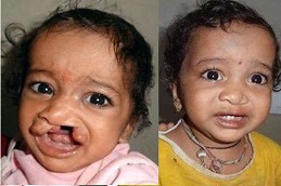 العيوب الخلقية في دبي