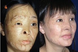 ترميم الحروق في دبي