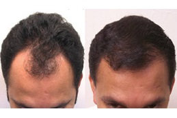 تكلفة زراعة الشعر في دبي