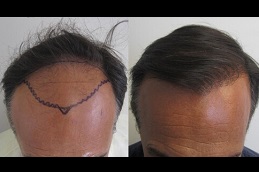 تكلفة عيادة زراعة الشعر في ابوظبي