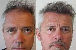 تكلفة عيادة زراعة الشعر في دبي وأبو ظبي