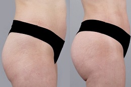 حقن الدهون في دبي