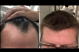 زراعة الشعر المباشر في دبي