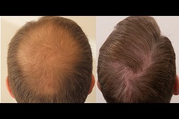 زراعة شعر الفوت في دبي