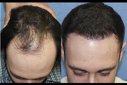 عيادة DHI لزراعة الشعر المباشر في أبو ظبي