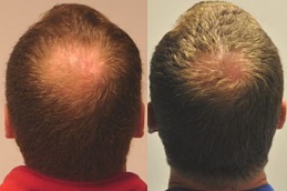 عيادة DHI لزراعة الشعر المباشر في دبي وأبو ظبي