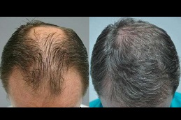عيادة زراعة الشعر في أبو ظبي