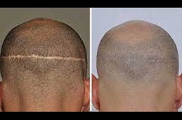 عيادة زراعة الشعر في دبي وأبو ظبي
