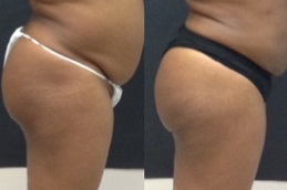 عيادة شد الجزء السفلي من الجسم في دبي وأبو ظبي