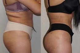 عيادة نقل الدهون في ابوظبي