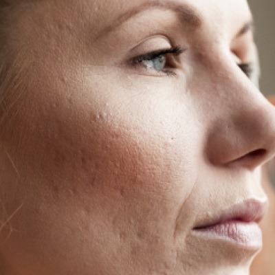 أفضل علاج للمسام الواسعة في دبي وأبو ظبي