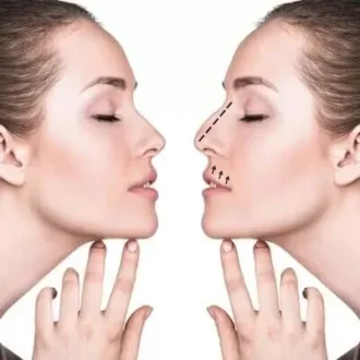 تكلفة عملية تجميل الأنف في دبي