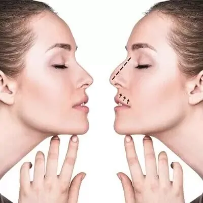 A Rhinoplasty-in-Dubai displays a whimsical transformation, as the womans unique nose, tilted upwards with a playful tilt, captivates. The skillful procedure stands out, enhancing her smile and adding a touch of humor to the image.