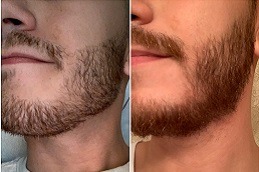 5 ways to fix your patchy beard Clinic in Dubai & Abu Dhabi