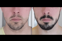 Best 5 ways to fix your patchy beard Clinic in Dubai
