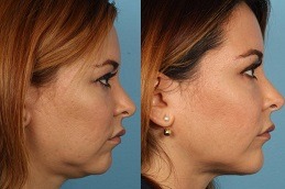 Best chin liposuction Clinic in Dubai & Abu Dhabi