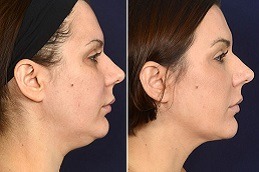 Best chin liposuction in Dubai