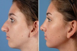 rhinoplasty nose reshaping in Dubai