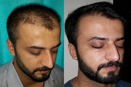 1 Dirham Hair Transplant in Dubai