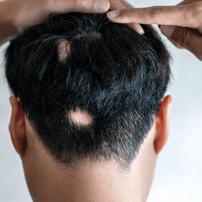 Alopecia Areata Treatment in Dubai, Abu Dhabi & Sharjah | Cost & Price