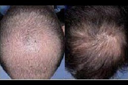 Best baldness treatment for males in Dubai