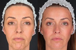 Best dermal fillers injections Clinic in Dubai & Abu Dhabi