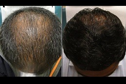 Best laser hair therapy for hair loss Clinic in Dubai