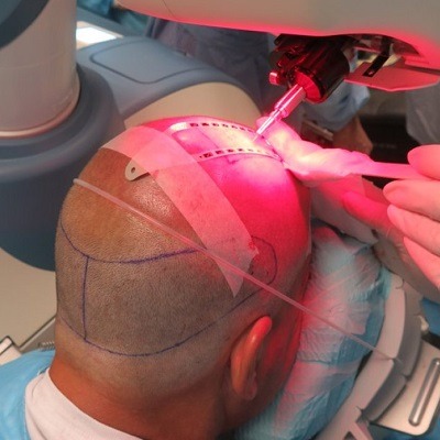 Robotic Hair Transplant in Dubai & Abu Dhabi - Cost & Deals Esthetic Clinic Dubai