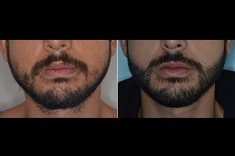 beard hair transplant Clinic in Abu Dhabi