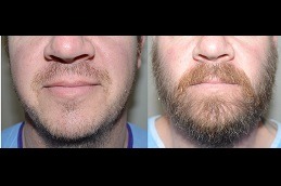 beard hair transplant in Dubai