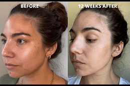 cheek fillers injections in Dubai