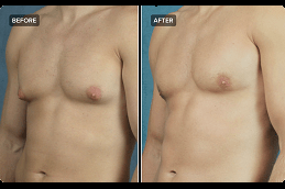 gynecomastia male breast reduction in Dubai