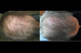laser hair therapy for hair loss Clinic in Abu Dhabi