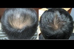 laser hair therapy for hair loss in Dubai