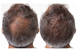 ACell PRP Therapy Hair Loss in Dubai & Abu Dhabi